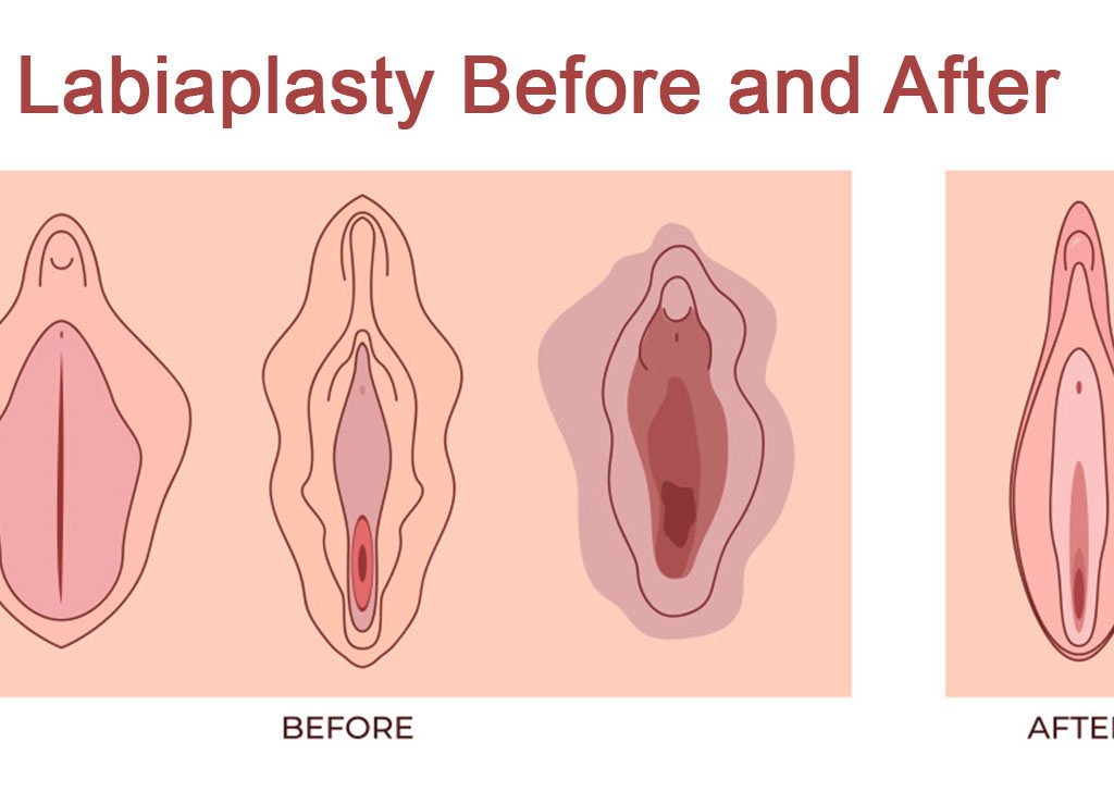 Labiaplasty Before and After