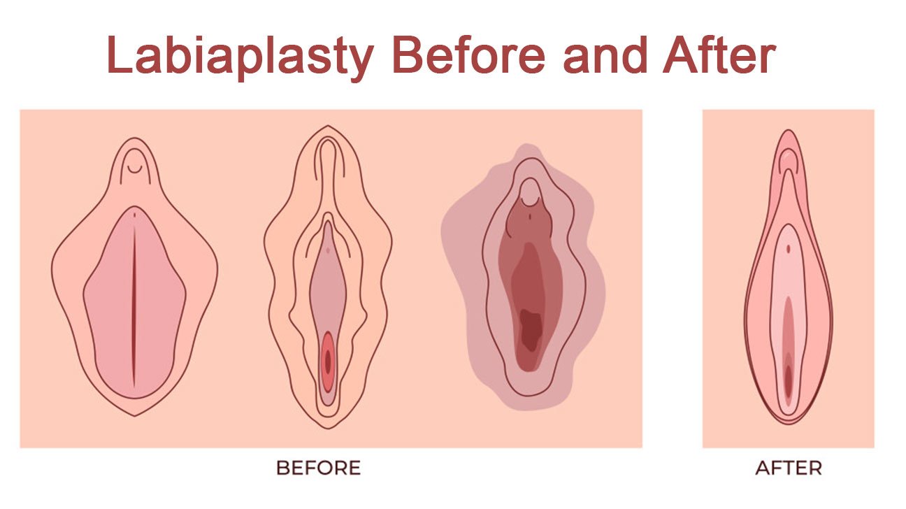 Labiaplasty Before and After