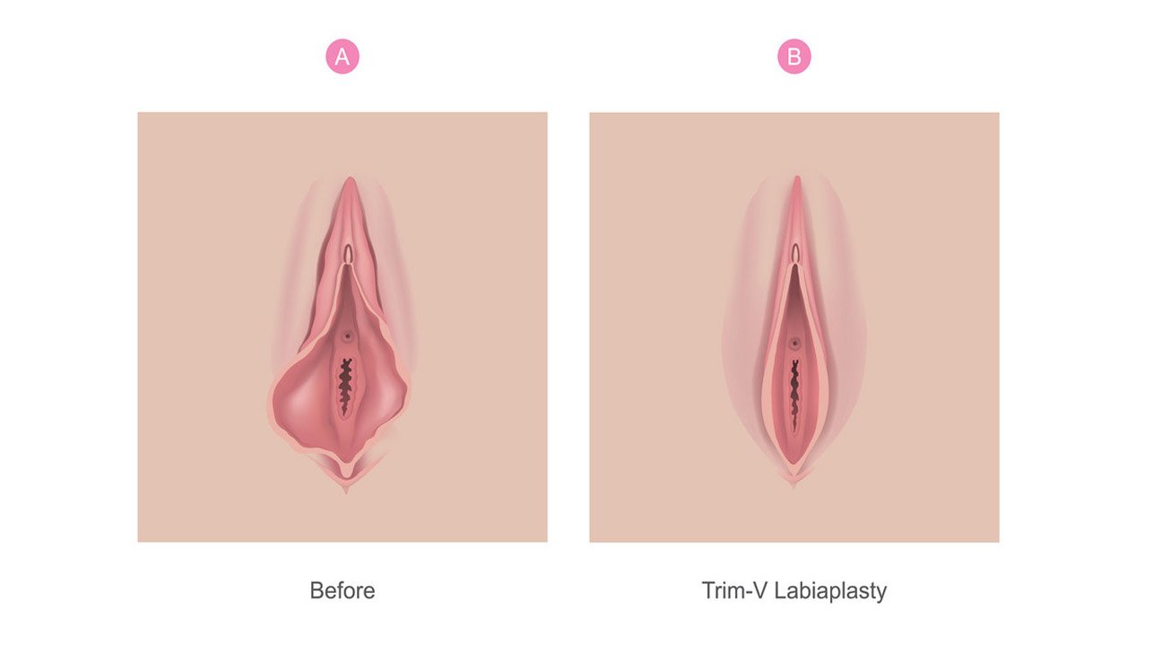 Labiaplasty