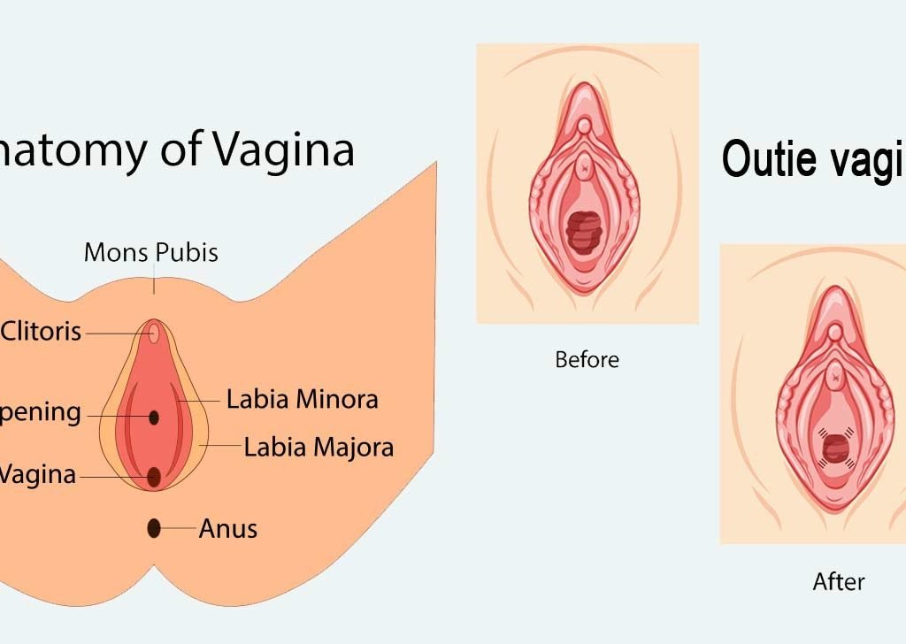 Outie-Vagina