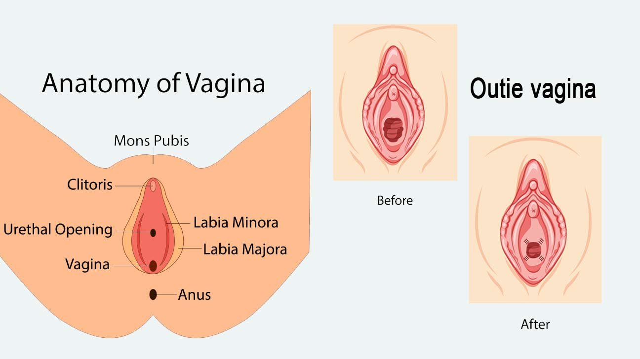 Outie-Vagina