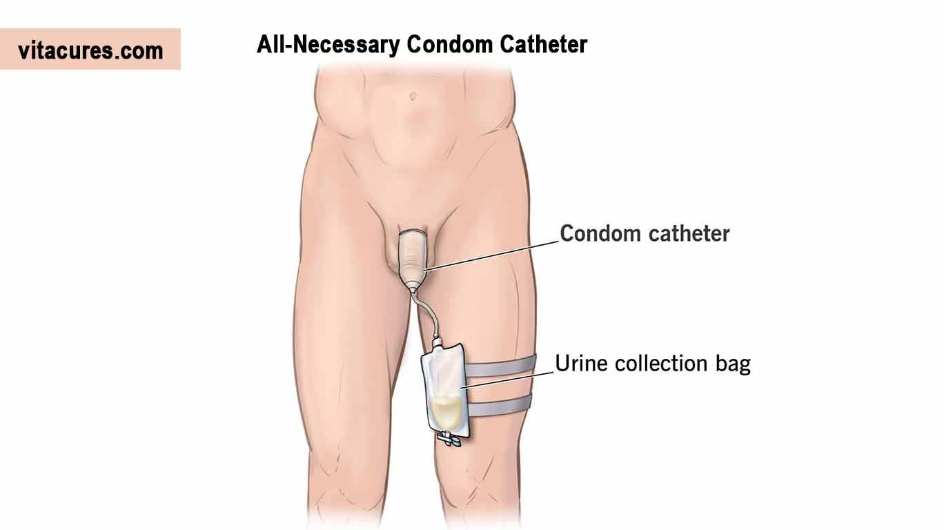 Condom-Catheter