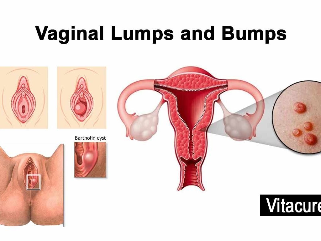 Vaginal Lumps and Bumps