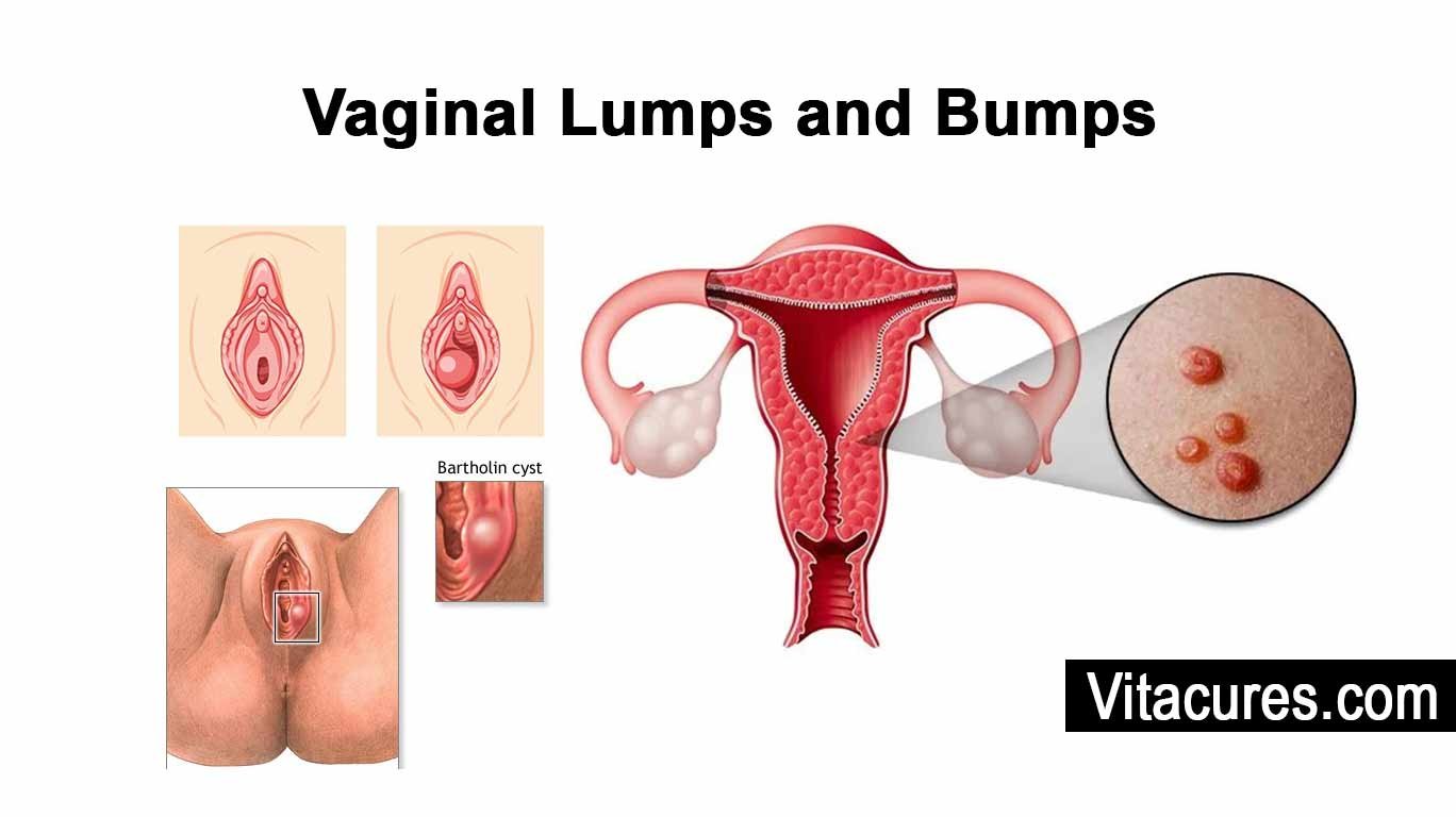 Vaginal Lumps and Bumps