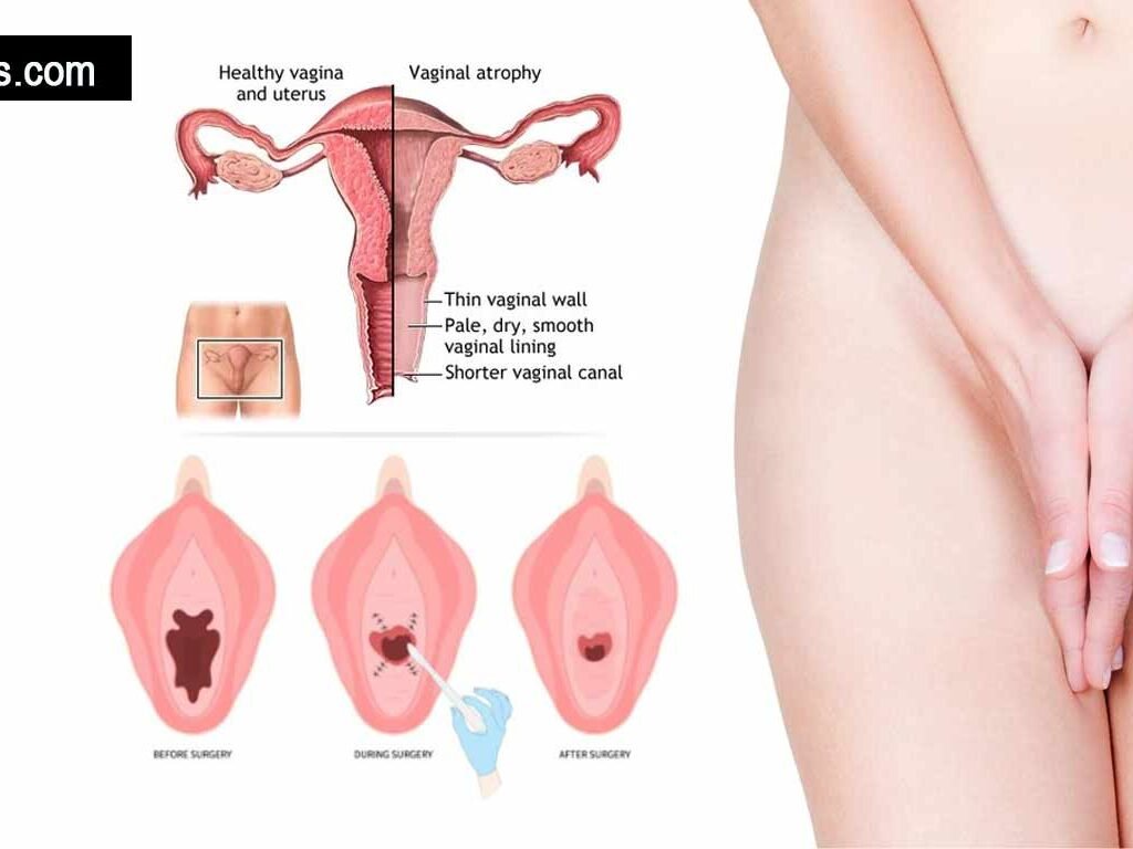 Vaginal Rejuvenation