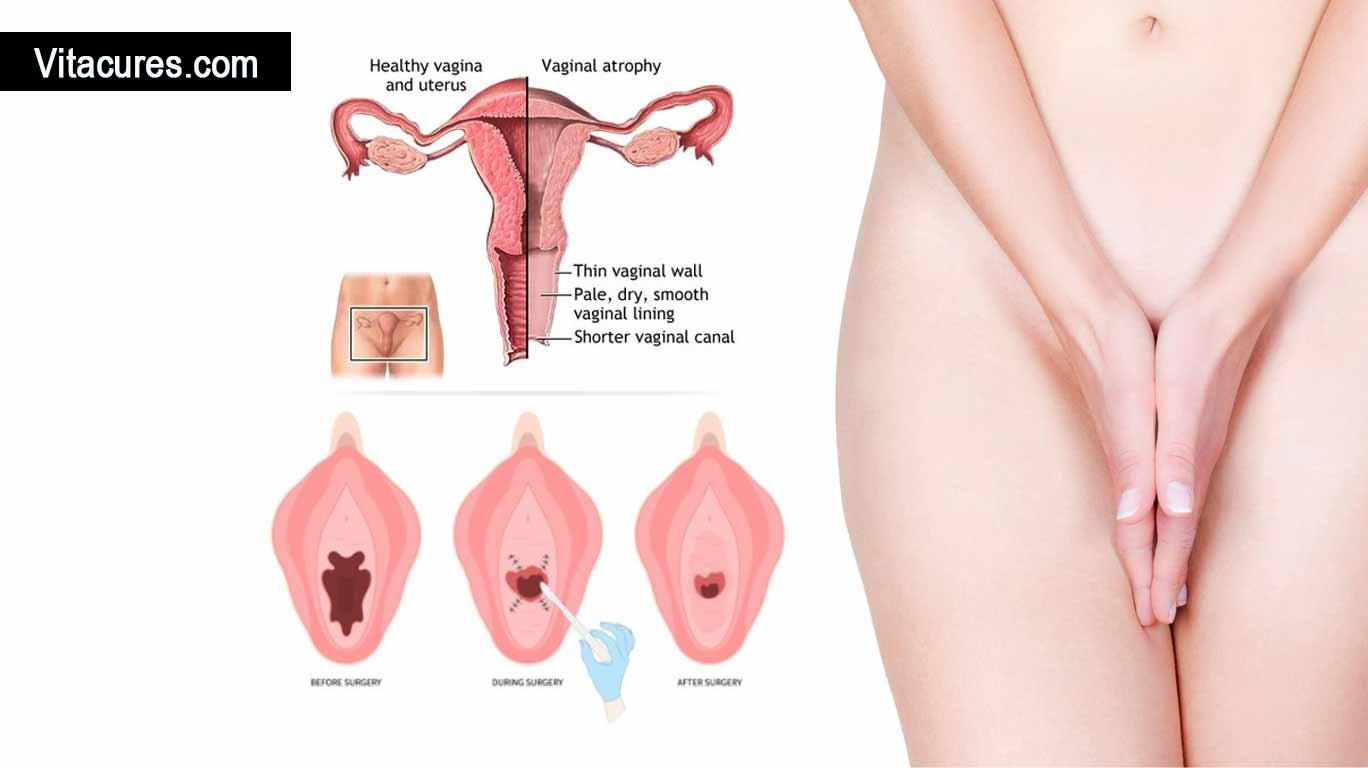 Vaginal Rejuvenation