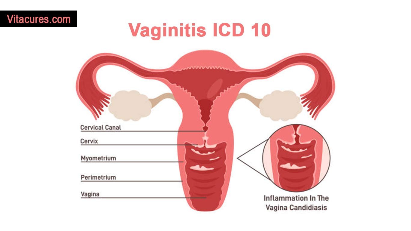 Vaginitis ICD 10