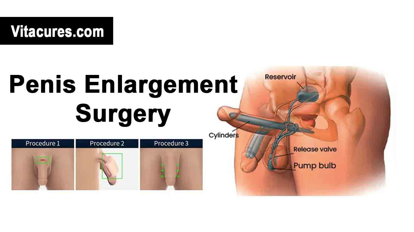 Penis Enlargement Surgery