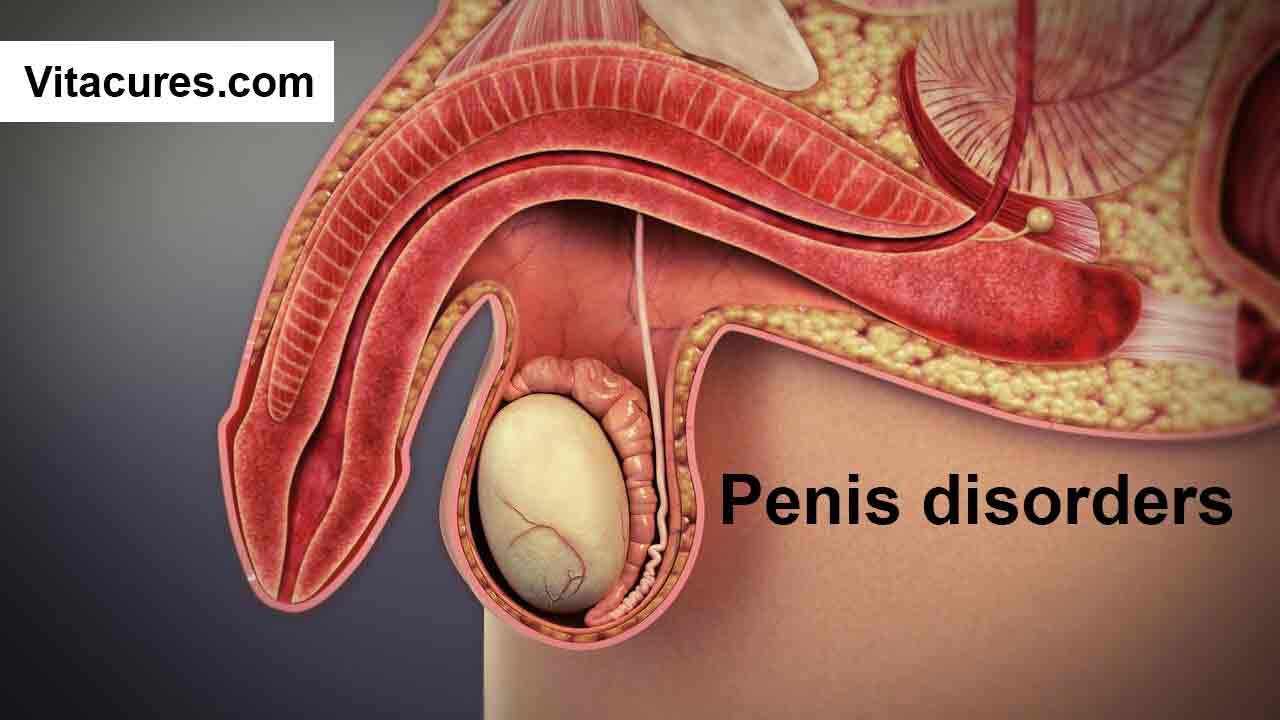 Penis disorders 