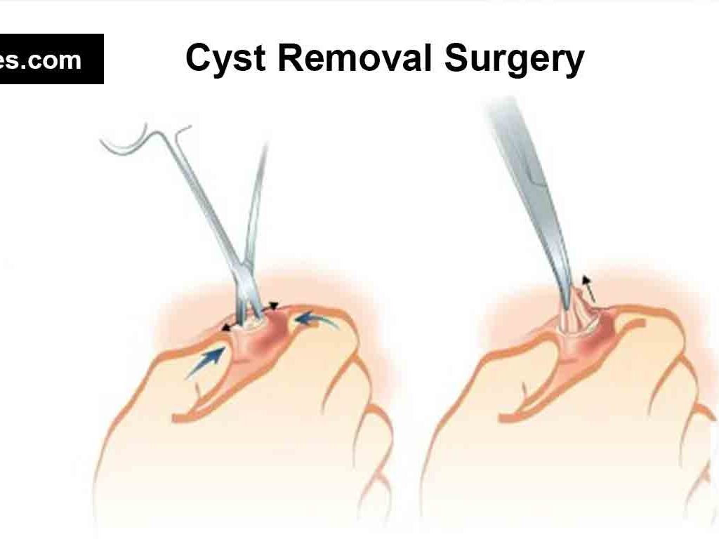 Cyst Removal Surgery