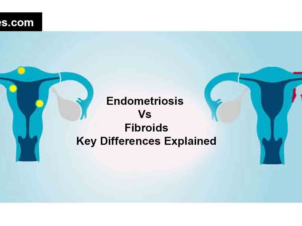 Endometriosis Vs Fibroids