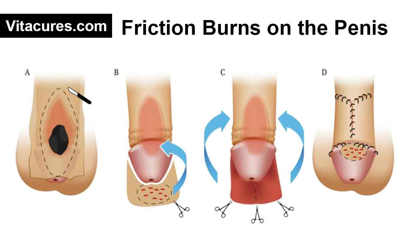 Friction Burns on the Penis