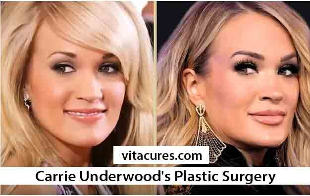7 Stunning Looks Carrie Underwood's Plastic Surgery Evolution VitaCures