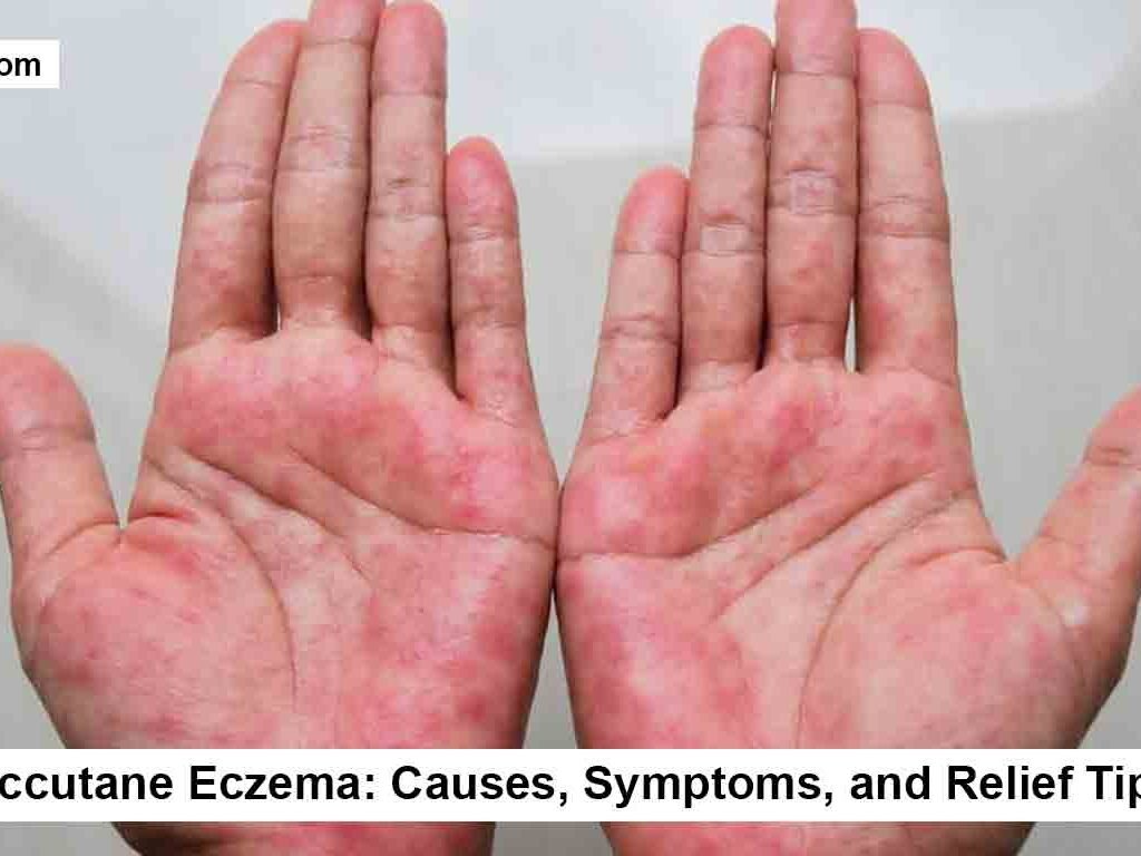 Accutane Eczema