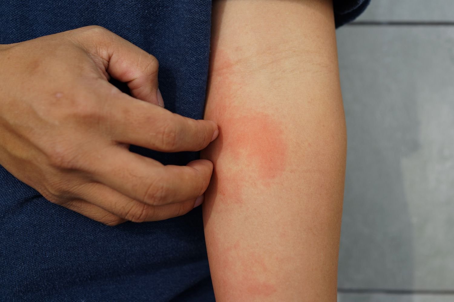 How to Treat Hormonal Eczema​?