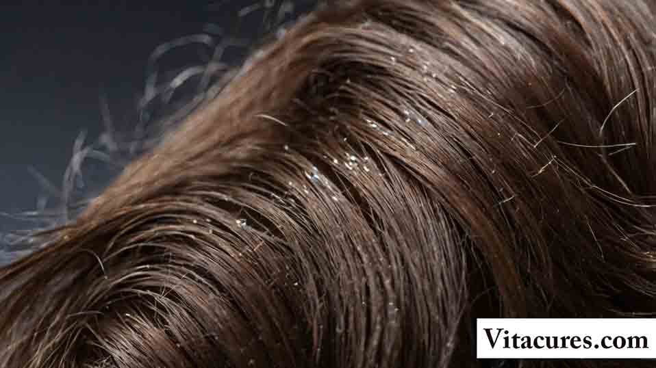 Dandruff Or Dry Scalp