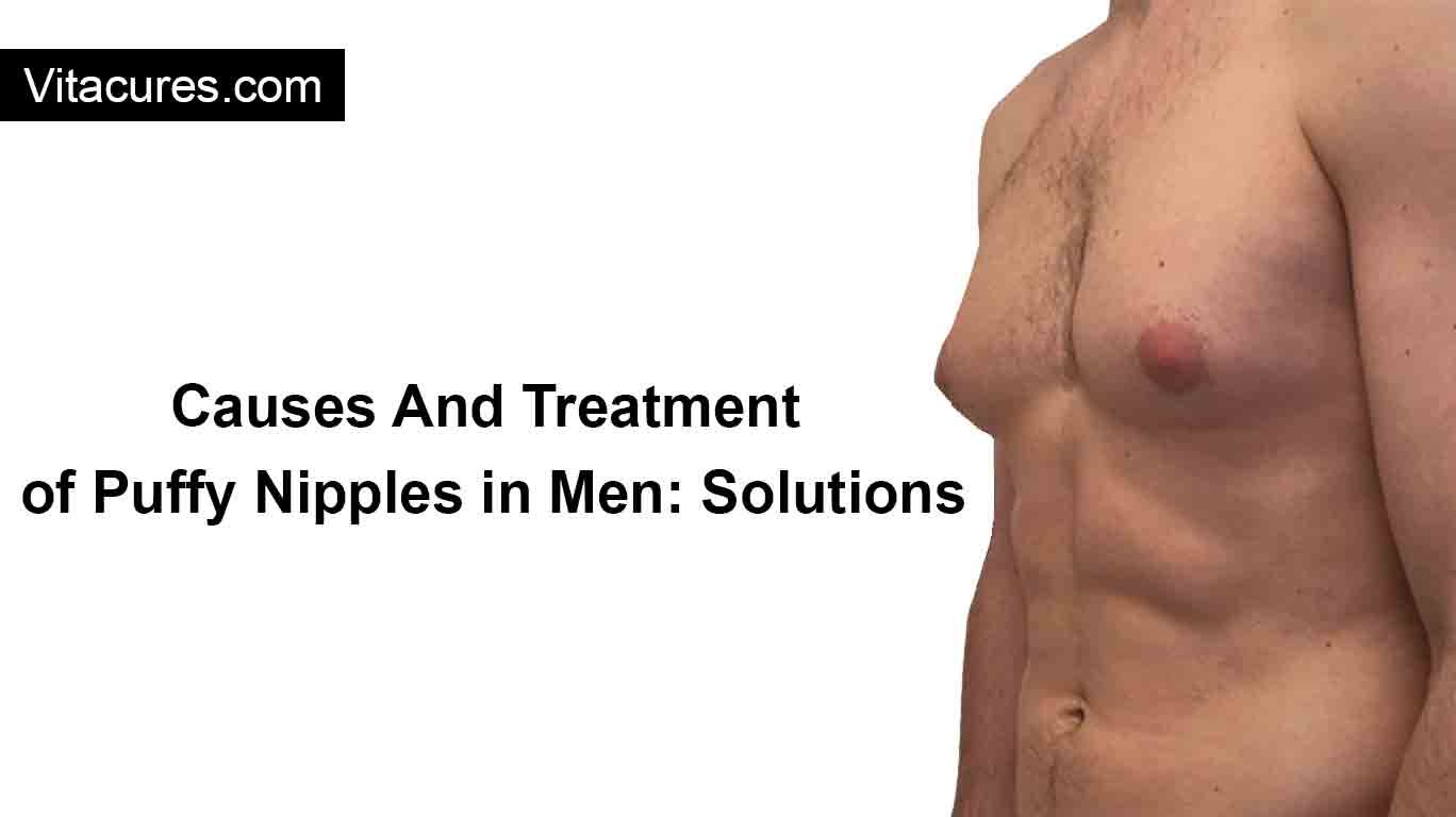 Puffy Nipples in Men